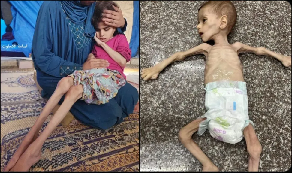 طفلة بلا دماغ .. تشوهات خلقية في غزة تكشف عن وجه جديد لحرب الإبادة الإسرائيلية بدعم أمريكي